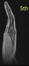 Figure 4 for case Ulnar aspect A3 pulley tear with bowstringing of the flexor tendons